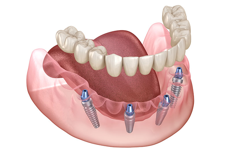 All on 4 Dental Implants in Galesburg